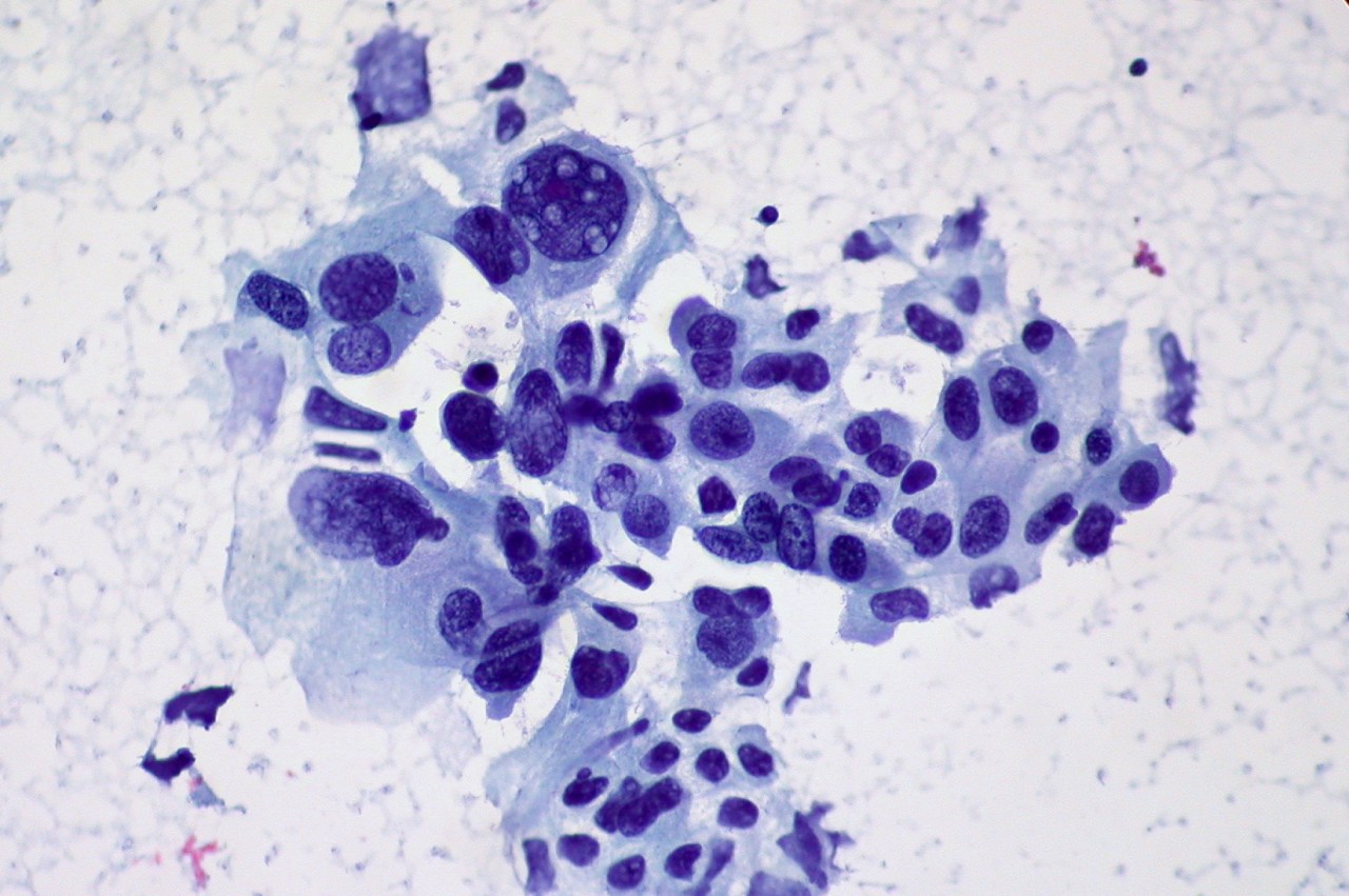 Revolutionizing Lung Cancer Diagnosis with AI: The Story of Infervision