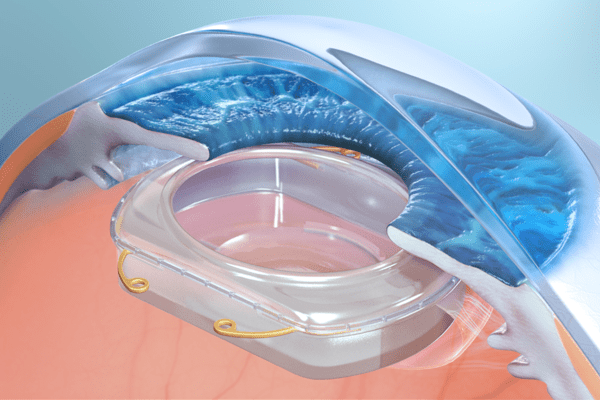 Revolutionizing Augmented Reality: The Future of Eye Implants with Omega Ophthalmics