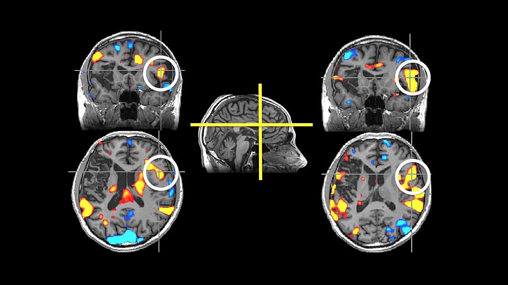 Tackling Stroke Diagnosis: How AI is Transforming Diagnostic Medicine